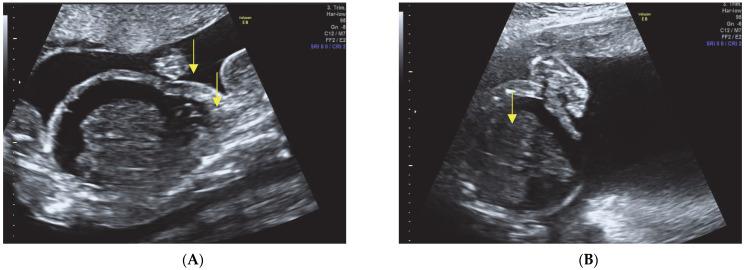 https://cdn.ncbi.nlm.nih.gov/pmc/blobs/64f4/10528460/76e0ea997ac8/diagnostics-13-02905-g003.jpg