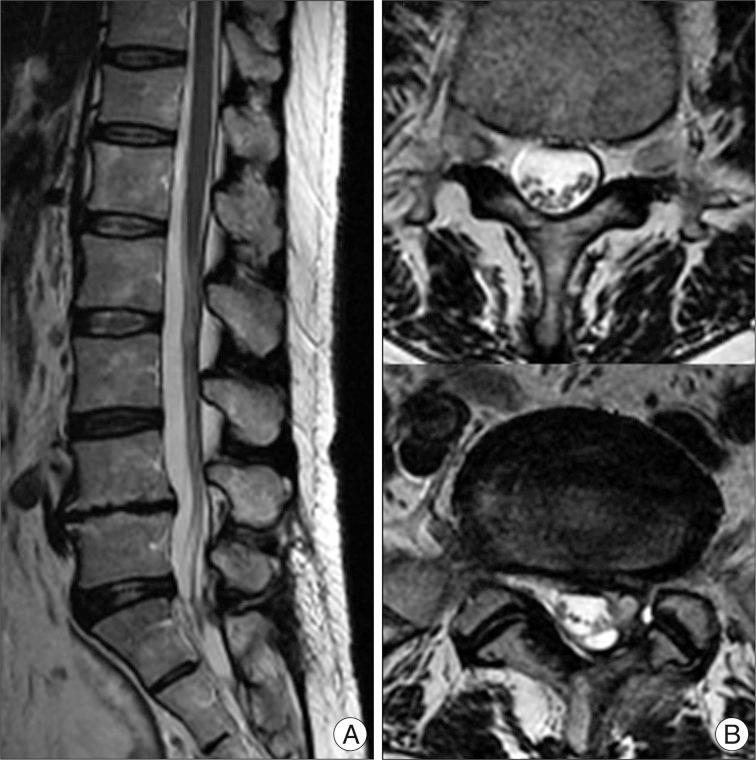 https://cdn.ncbi.nlm.nih.gov/pmc/blobs/650d/3539087/ddf0afe1a106/jkns-52-491-g006.jpg