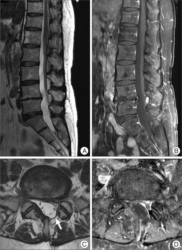 https://cdn.ncbi.nlm.nih.gov/pmc/blobs/650d/3539087/e3b34d0d8a64/jkns-52-491-g001.jpg
