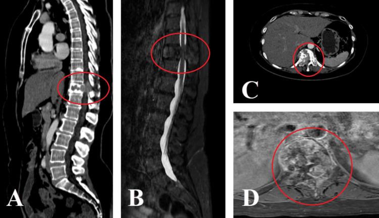 https://cdn.ncbi.nlm.nih.gov/pmc/blobs/652e/11523553/0d9a70349750/cureus-0016-00000070503-i01.jpg