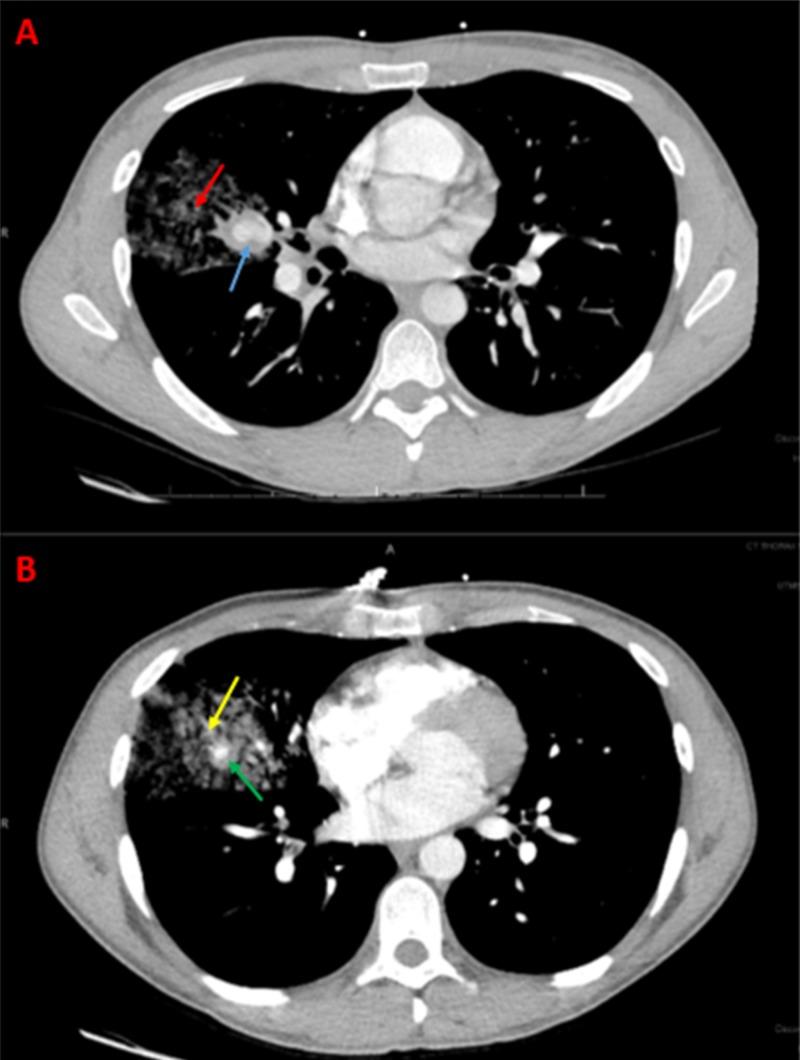 https://cdn.ncbi.nlm.nih.gov/pmc/blobs/6530/6333258/bf33e9e90b46/cureus-0010-00000003576-i01.jpg