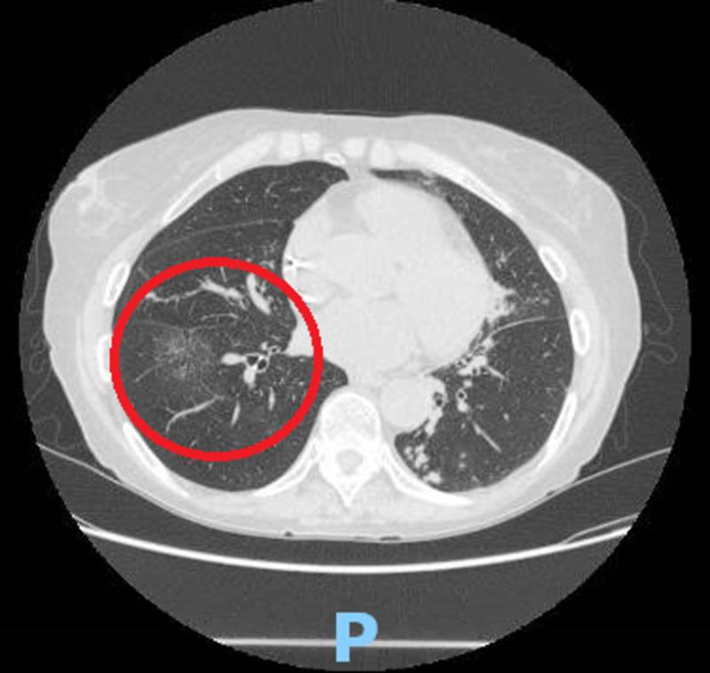 https://cdn.ncbi.nlm.nih.gov/pmc/blobs/6554/7594666/2b6215d432a9/cureus-0012-00000010713-i01.jpg