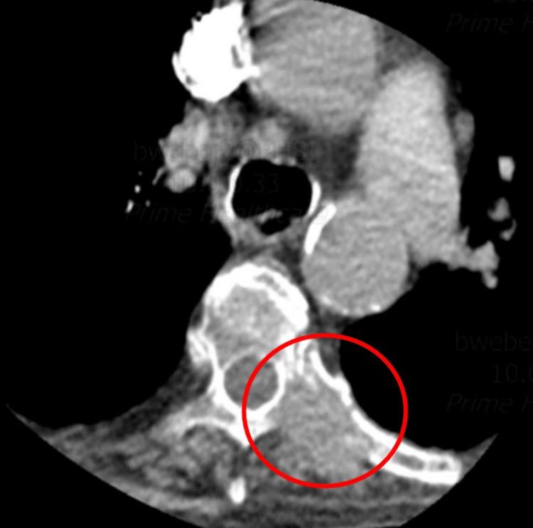 https://cdn.ncbi.nlm.nih.gov/pmc/blobs/657f/9527109/8fbc47bd5611/cureus-0014-00000028706-i02.jpg