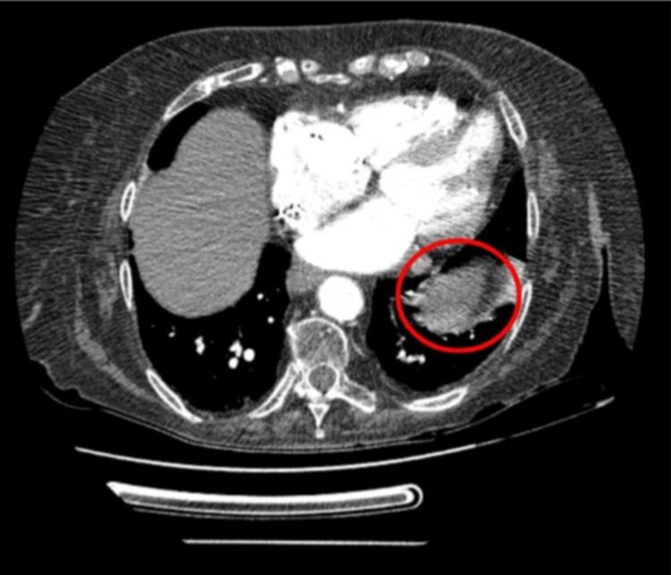 https://cdn.ncbi.nlm.nih.gov/pmc/blobs/657f/9527109/d57408a089d1/cureus-0014-00000028706-i01.jpg