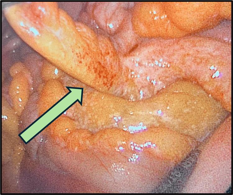 https://cdn.ncbi.nlm.nih.gov/pmc/blobs/6588/11149916/dc3176e0ed9f/cureus-0016-00000059682-i02.jpg