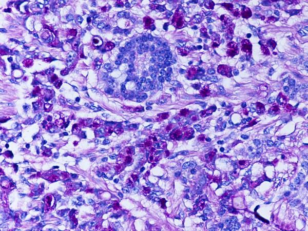 https://cdn.ncbi.nlm.nih.gov/pmc/blobs/65e7/2174438/4360955b94cf/1746-1596-2-43-3.jpg