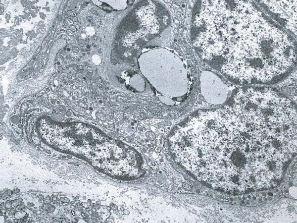 https://cdn.ncbi.nlm.nih.gov/pmc/blobs/65e7/2174438/a8401bd4e18f/1746-1596-2-43-10.jpg