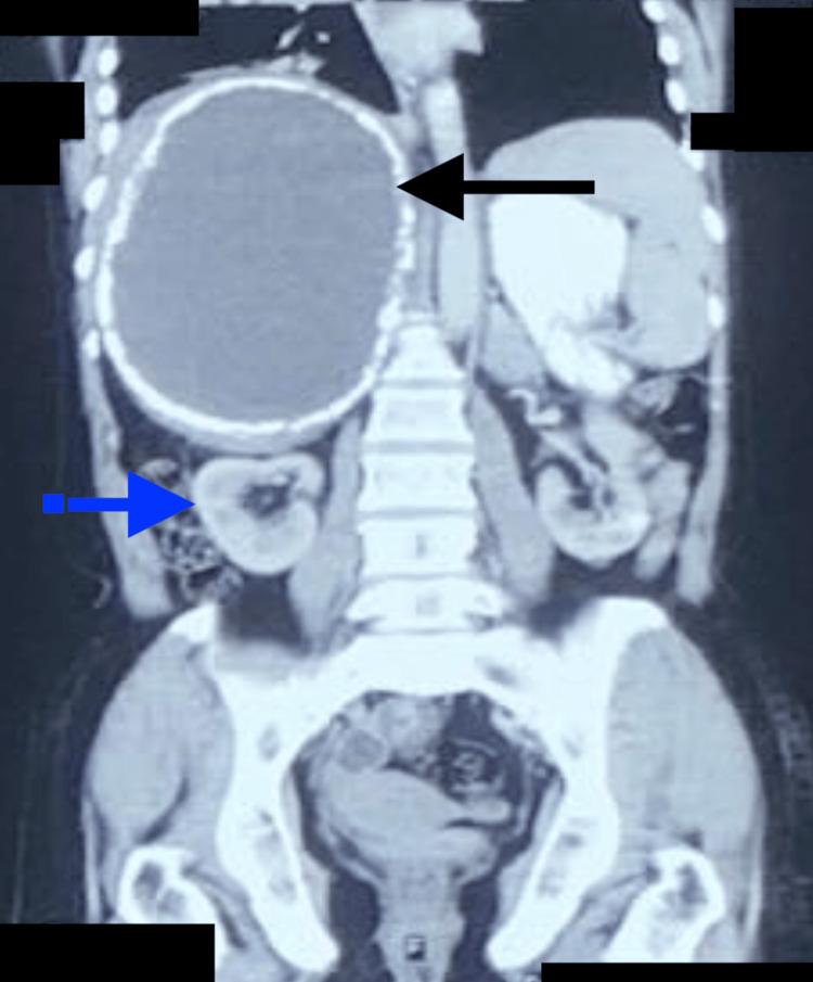 https://cdn.ncbi.nlm.nih.gov/pmc/blobs/660a/11041523/6f0bbc7783eb/cureus-0016-00000056876-i04.jpg