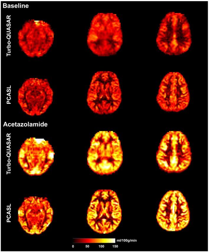 https://cdn.ncbi.nlm.nih.gov/pmc/blobs/667f/6899879/efe611f29227/MRM-83-731-g003.jpg