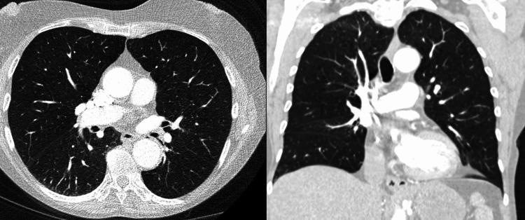 https://cdn.ncbi.nlm.nih.gov/pmc/blobs/66f1/12181990/d17e6b54014e/cureus-0017-00000084612-i02.jpg