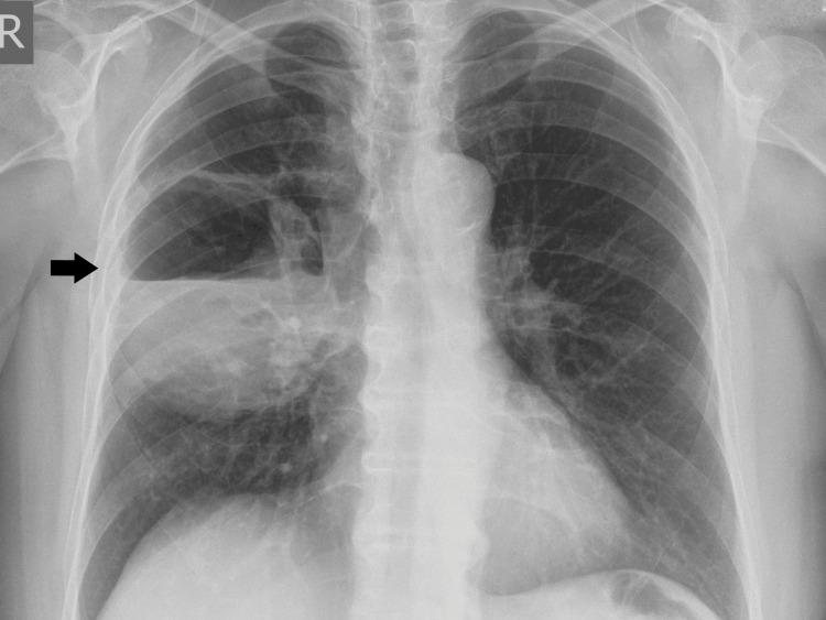 https://cdn.ncbi.nlm.nih.gov/pmc/blobs/672b/11917460/07f810749ac8/cureus-0017-00000079090-i01.jpg