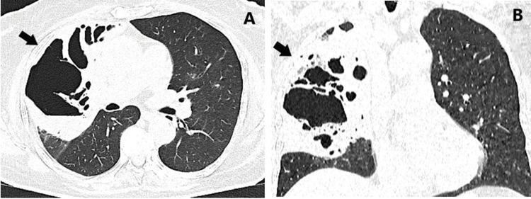 https://cdn.ncbi.nlm.nih.gov/pmc/blobs/672b/11917460/9ee046ecc3e6/cureus-0017-00000079090-i02.jpg