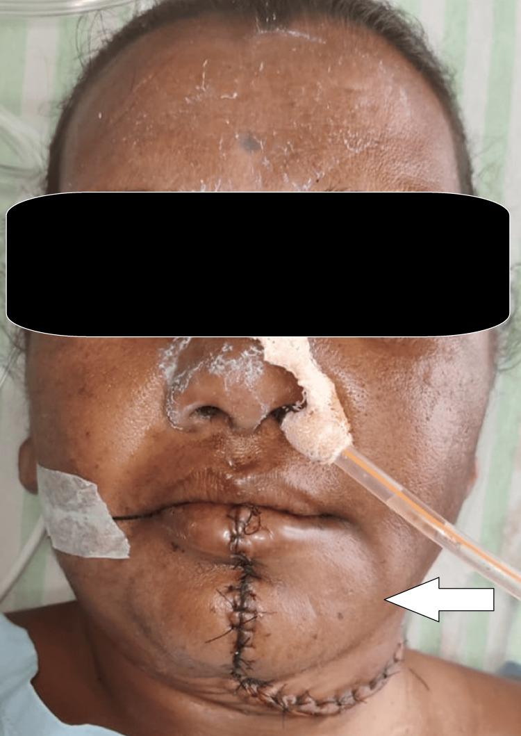 https://cdn.ncbi.nlm.nih.gov/pmc/blobs/6753/12243677/2a4e690de3b2/cureus-0017-00000085690-i05.jpg