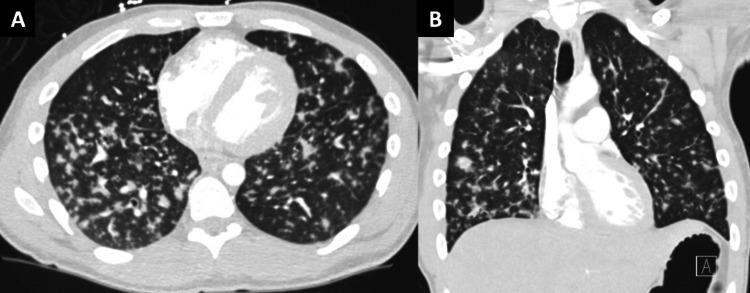 https://cdn.ncbi.nlm.nih.gov/pmc/blobs/6763/11794192/02e555c0bb28/cureus-0017-00000076972-i01.jpg