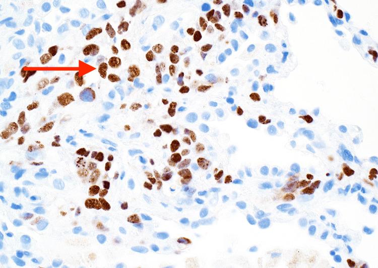 https://cdn.ncbi.nlm.nih.gov/pmc/blobs/6763/11794192/6b2a5b03c365/cureus-0017-00000076972-i03.jpg