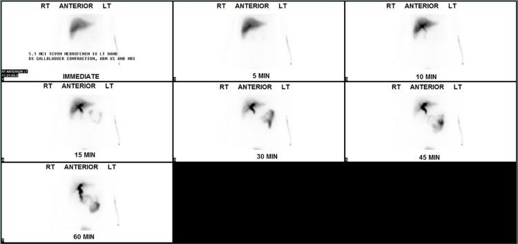 https://cdn.ncbi.nlm.nih.gov/pmc/blobs/677e/9616560/748189c0d42e/cureus-0014-00000030753-i03.jpg