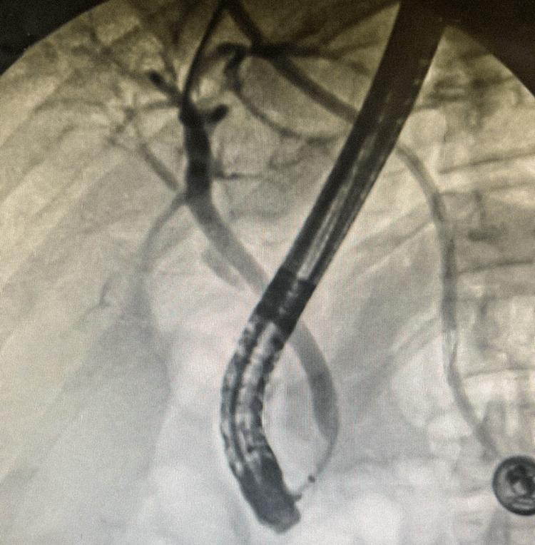 https://cdn.ncbi.nlm.nih.gov/pmc/blobs/677e/9616560/a2cab2759955/cureus-0014-00000030753-i06.jpg