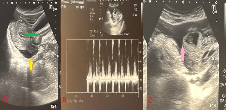 https://cdn.ncbi.nlm.nih.gov/pmc/blobs/67b6/12051073/c794bc50bf88/cureus-0017-00000081605-i01.jpg