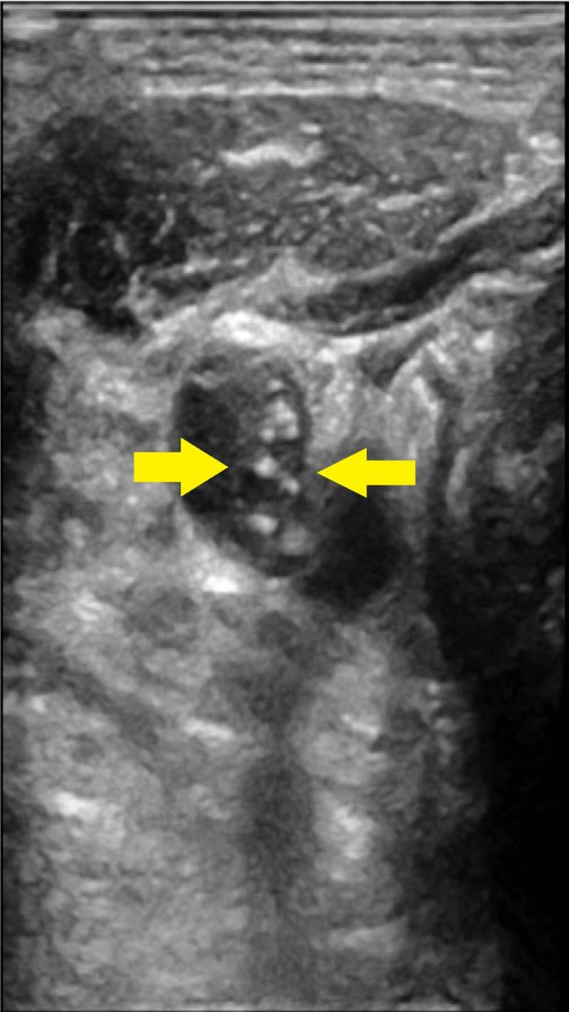 https://cdn.ncbi.nlm.nih.gov/pmc/blobs/6823/7105036/a8641f9a4025/cureus-0012-00000007443-i04.jpg