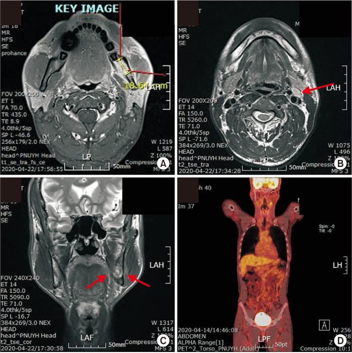 https://cdn.ncbi.nlm.nih.gov/pmc/blobs/689c/8084740/0e41a756d27e/jkaoms-47-2-120-f7.jpg