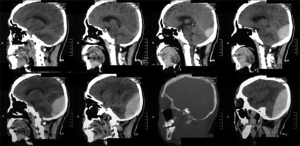 https://cdn.ncbi.nlm.nih.gov/pmc/blobs/68d0/5898130/851f1b0f762a/AJNS-13-453-g004.jpg