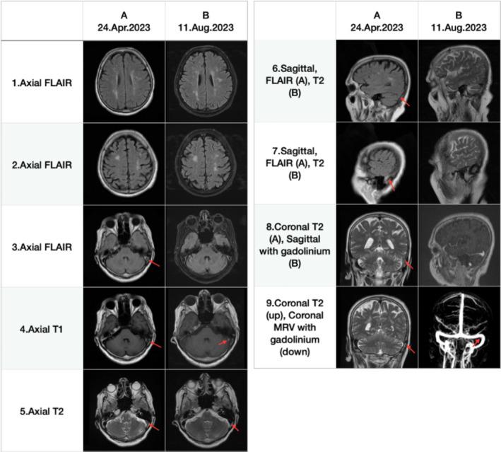 https://cdn.ncbi.nlm.nih.gov/pmc/blobs/68fe/11723831/e169d14f9061/CCR3-13-e70038-g002.jpg