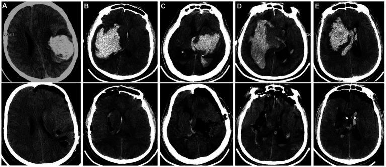 https://cdn.ncbi.nlm.nih.gov/pmc/blobs/6968/10576608/5ebd22f39e1e/fneur-14-1238283-g001.jpg