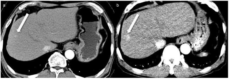 https://cdn.ncbi.nlm.nih.gov/pmc/blobs/6970/12197165/4b1dc414696d/tomography-11-00066-g003.jpg
