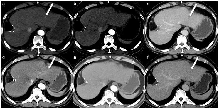 https://cdn.ncbi.nlm.nih.gov/pmc/blobs/6970/12197165/9e6f868aedf0/tomography-11-00066-g002.jpg