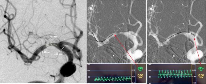 https://cdn.ncbi.nlm.nih.gov/pmc/blobs/69c1/8385769/39d4e9e61cf6/fneur-12-671778-g0001.jpg
