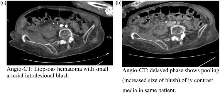 https://cdn.ncbi.nlm.nih.gov/pmc/blobs/69c6/7877978/a3c6b0aff797/IANN_A_1875498_F0001_B.jpg