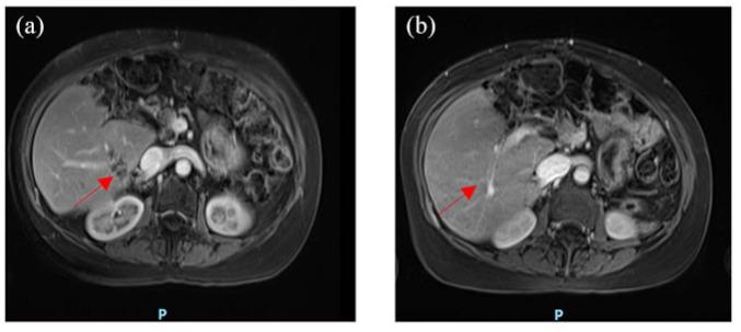 https://cdn.ncbi.nlm.nih.gov/pmc/blobs/69cb/8264726/ec926871f339/10.1177_17588359211018539-fig2.jpg