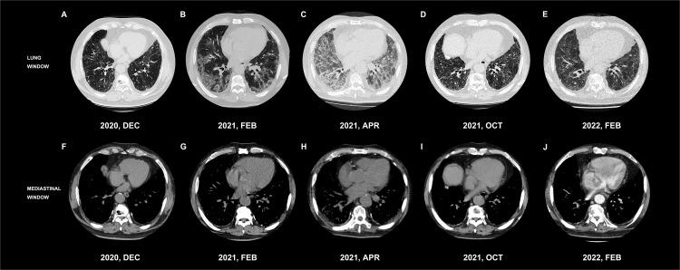 https://cdn.ncbi.nlm.nih.gov/pmc/blobs/69f3/9872202/bf3ca9b97dba/fimmu-13-1072612-g002.jpg