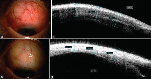 https://cdn.ncbi.nlm.nih.gov/pmc/blobs/6a44/12258829/4536b73cb33f/OJO-18-155-g002.jpg