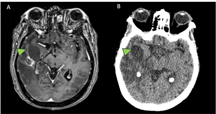 https://cdn.ncbi.nlm.nih.gov/pmc/blobs/6a54/10870692/223c5678a1b1/cureus-0016-00000052383-i02.jpg