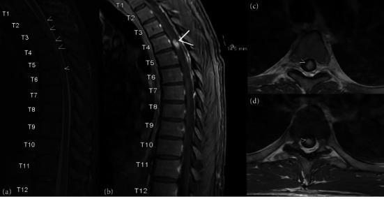 https://cdn.ncbi.nlm.nih.gov/pmc/blobs/6a83/11986188/82defbcd867f/CRIID2025-1124517.001.jpg