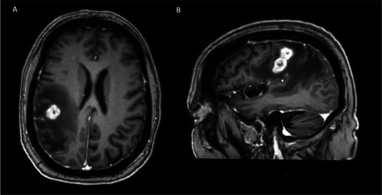 https://cdn.ncbi.nlm.nih.gov/pmc/blobs/6a88/11073547/015c3c03d79d/cureus-0016-00000057717-i01.jpg
