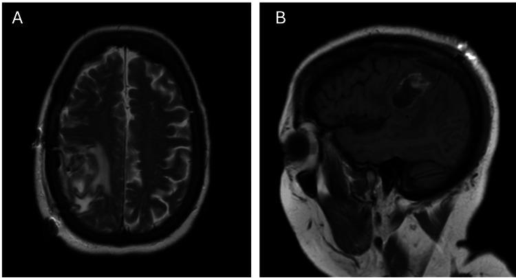 https://cdn.ncbi.nlm.nih.gov/pmc/blobs/6a88/11073547/7598e2920d2f/cureus-0016-00000057717-i03.jpg