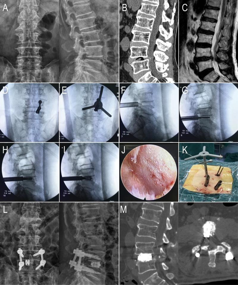 https://cdn.ncbi.nlm.nih.gov/pmc/blobs/6aae/9240389/3b9998bdb503/fsurg-09-916087-g001.jpg