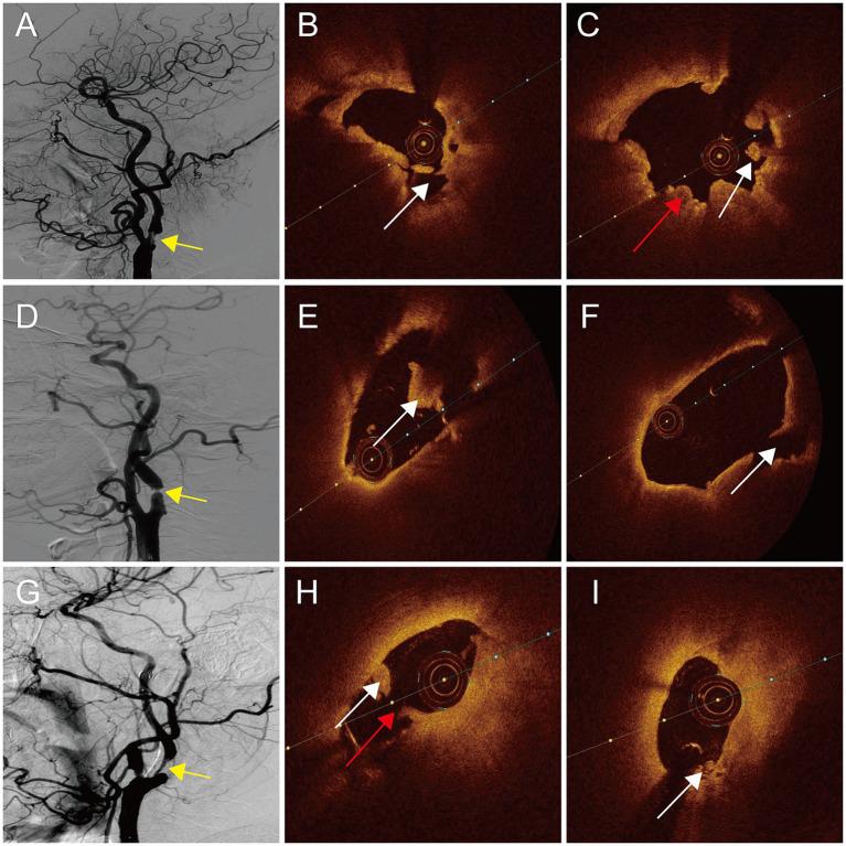 https://cdn.ncbi.nlm.nih.gov/pmc/blobs/6ac3/11392725/ebebef810765/fneur-15-1445227-g003.jpg