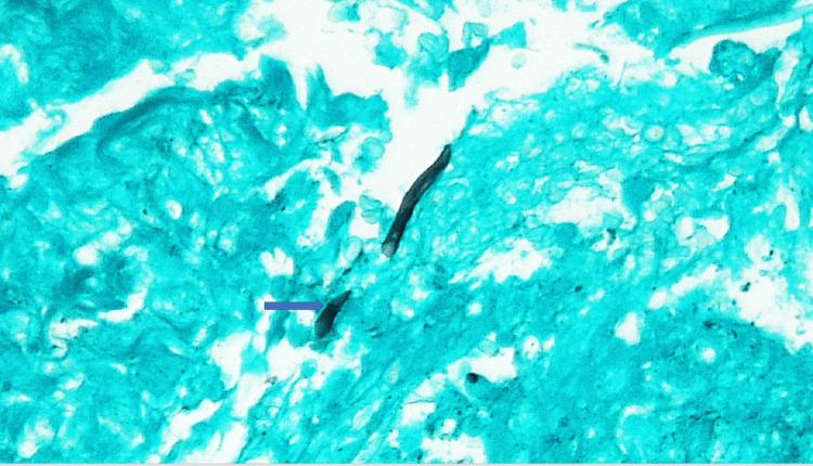 https://cdn.ncbi.nlm.nih.gov/pmc/blobs/6b0f/9579060/629ebb916998/cureus-0014-00000029303-i05.jpg
