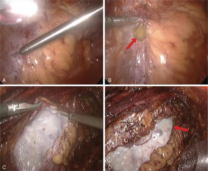 https://cdn.ncbi.nlm.nih.gov/pmc/blobs/6b15/4902365/e7b7b8ede01d/medi-95-e3751-g004.jpg