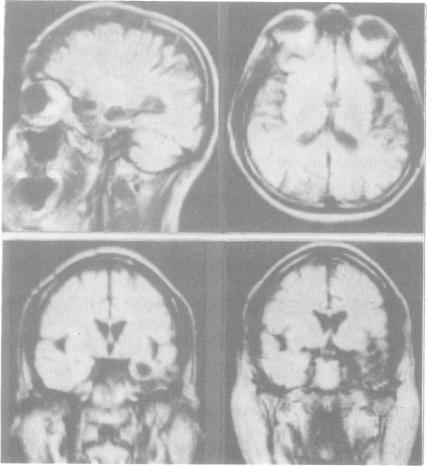https://cdn.ncbi.nlm.nih.gov/pmc/blobs/6b93/1032917/1ee321c6fafe/jnnpsyc00545-0043-a.jpg