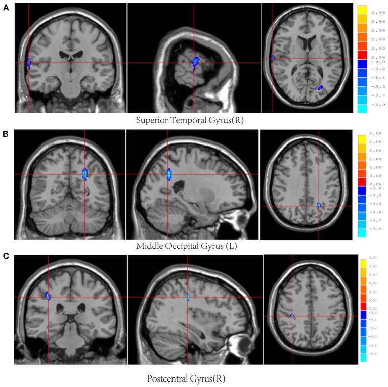 https://cdn.ncbi.nlm.nih.gov/pmc/blobs/6ba0/8825420/e5b802ec089d/fneur-12-755152-g0001.jpg
