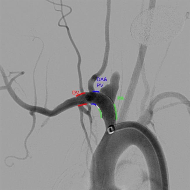https://cdn.ncbi.nlm.nih.gov/pmc/blobs/6bd6/5869458/705422f3647b/neurintsurg-2017-013175f01.jpg