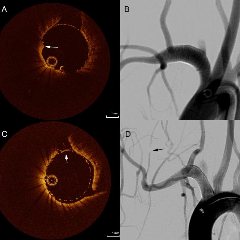 https://cdn.ncbi.nlm.nih.gov/pmc/blobs/6bd6/5869458/96d899ce65d4/neurintsurg-2017-013175f03.jpg