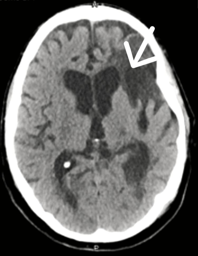 https://cdn.ncbi.nlm.nih.gov/pmc/blobs/6bd7/11519829/b233d5e8b063/cureus-0016-00000070423-i04.jpg