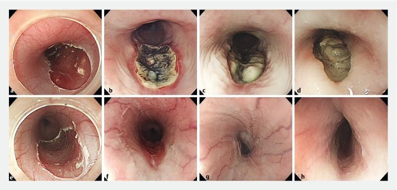 https://cdn.ncbi.nlm.nih.gov/pmc/blobs/6c2b/6336468/e9a2edc44aea/10-1055-a-0781-2333-i1285ei2.jpg