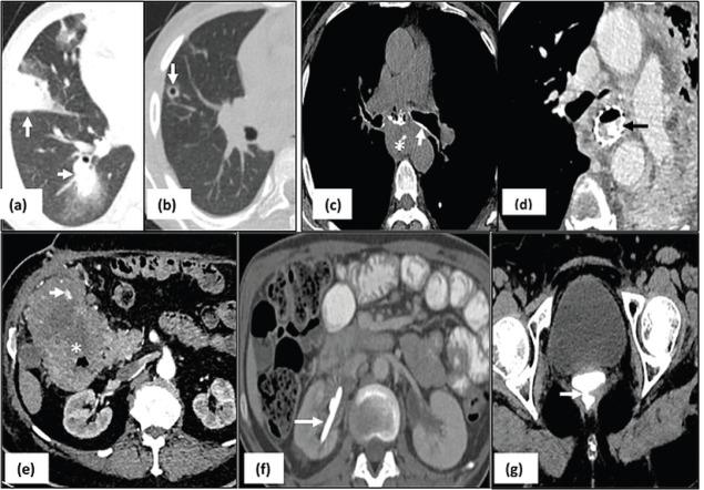 https://cdn.ncbi.nlm.nih.gov/pmc/blobs/6c46/10151087/4716180d57bc/can-17-1529fig5.jpg