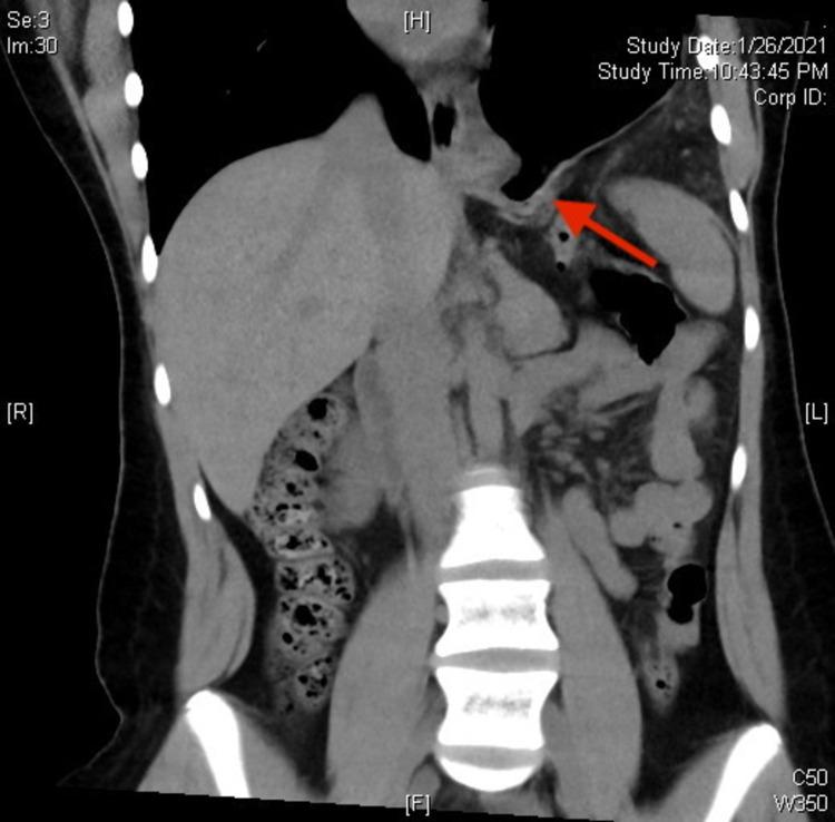 https://cdn.ncbi.nlm.nih.gov/pmc/blobs/6c8a/9107306/4febfe1da104/cureus-0014-00000024141-i02.jpg